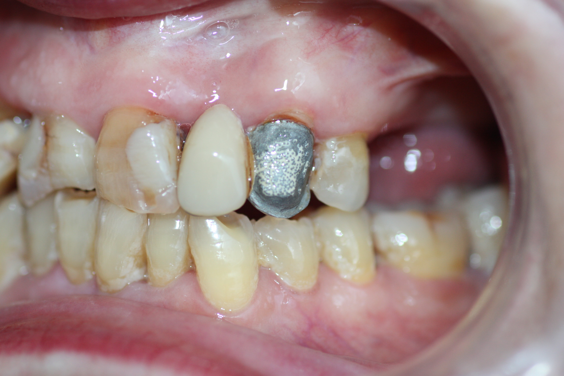 Corona o prótesis caída